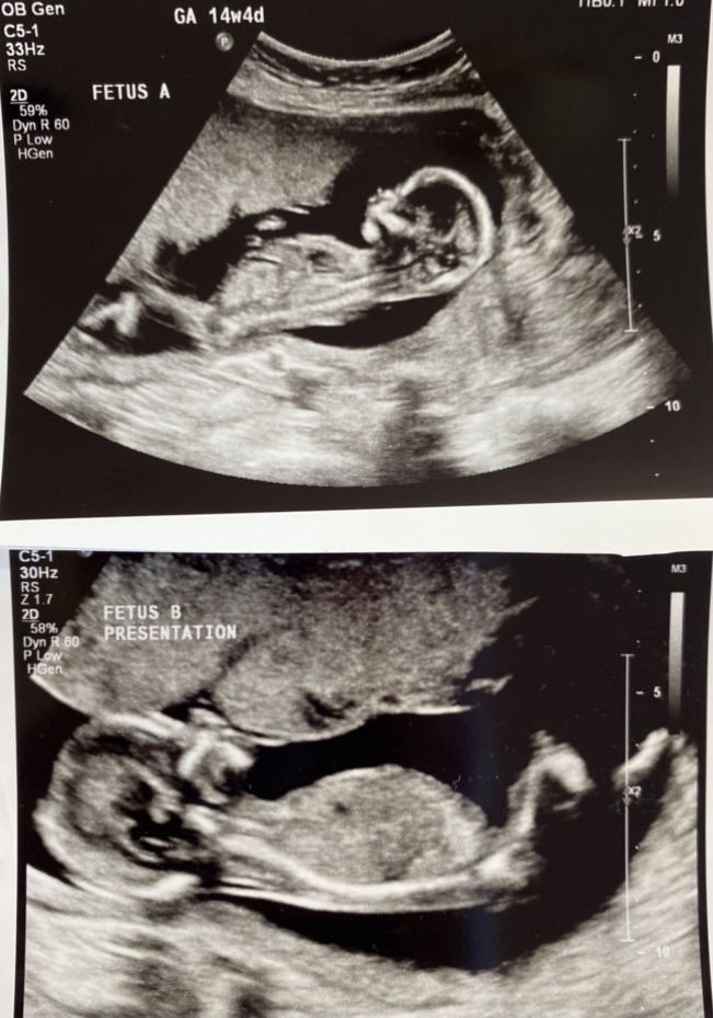 twins ultrasound 30 weeks